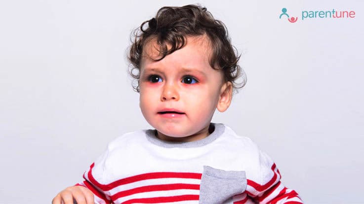 आंखों में इंफैक्शन (Conjunctivitis) के लिए घरेलू उपचार