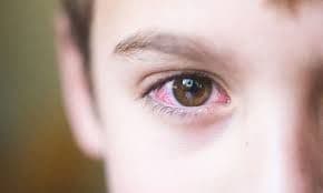 डोळे येणे (Conjunctivitis) : घरगुती उपचार 