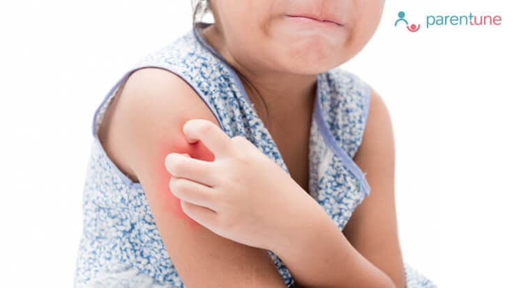 What Can Cause Eczema? How to Treat Eczema in Toddlers?
