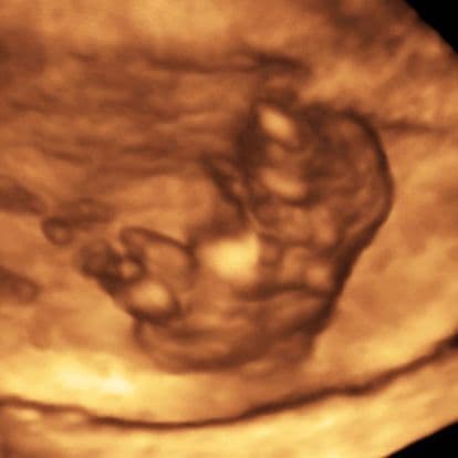 9 Weeks 6 Days Pregnant