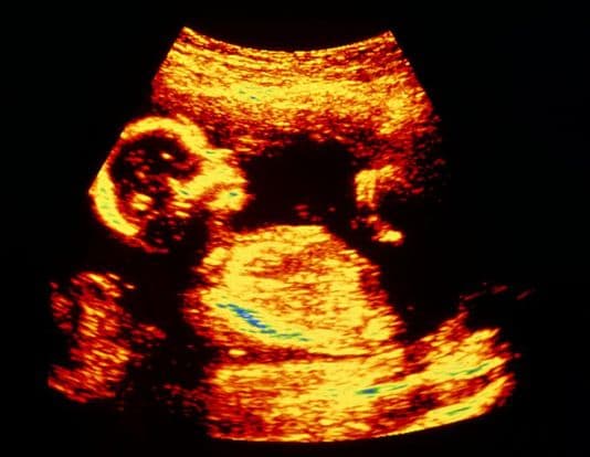 18 weeks and 4 days pregnant
