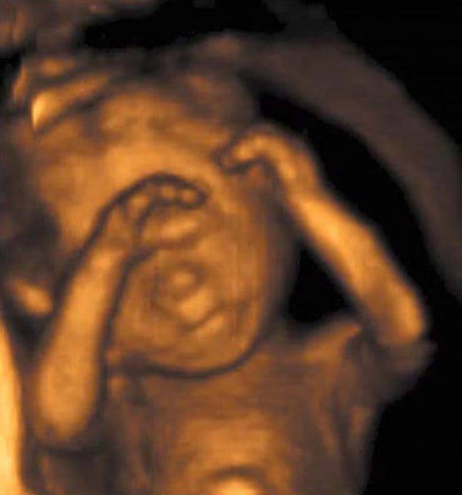 18 weeks and 7 days pregnant