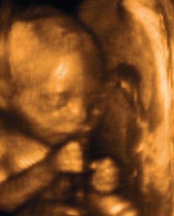 Ultrasound image at pregnancy week 23
