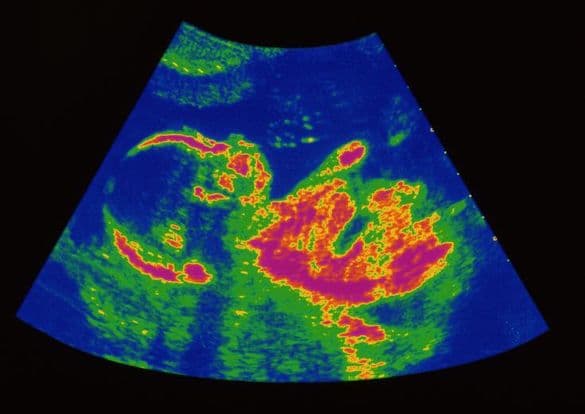 23 weeks and 5 days pregnant
