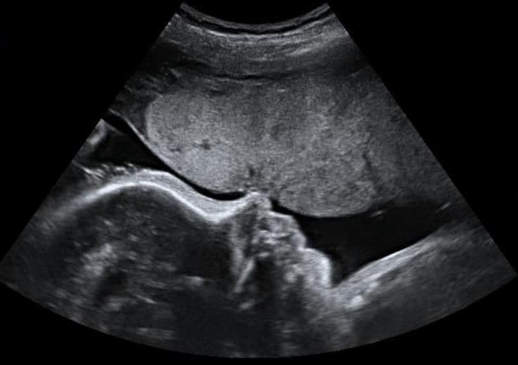 34 weeks and 1 day pregnant
