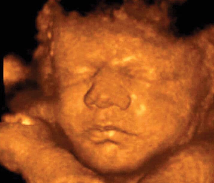 Ultrasound image at pregnancy week 35