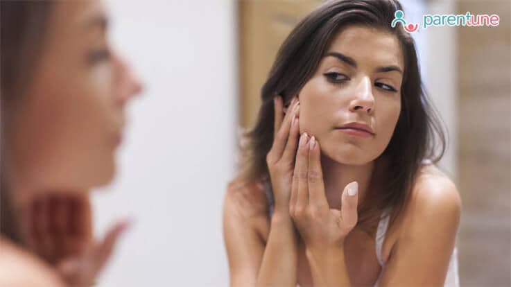 Acne In Pregnancy - How To Treat It?