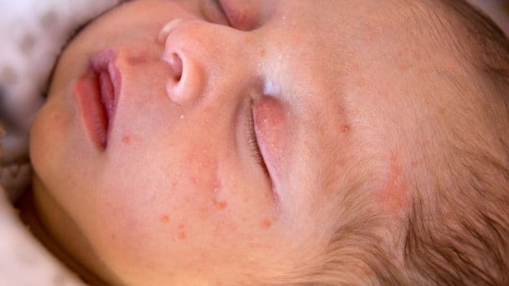 Baby acne: Are you worried about pimples
