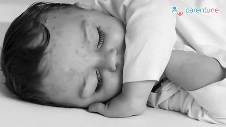 Chicken Pox in Babies – Causes, Prevention, Treatment Tips & Remedies