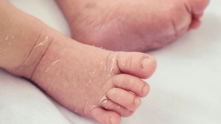 Dry Skin In Babies: 8 Ways To Deal With It