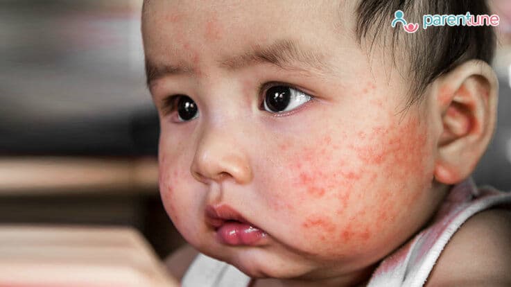 Eczema in Babies – Symptoms, Causes and How to Diagnose Tips, Remedies