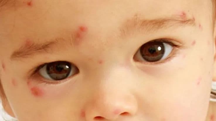 How to Protect Child from Chicken Pox, Risks Factors, Precautions - A mother's experience