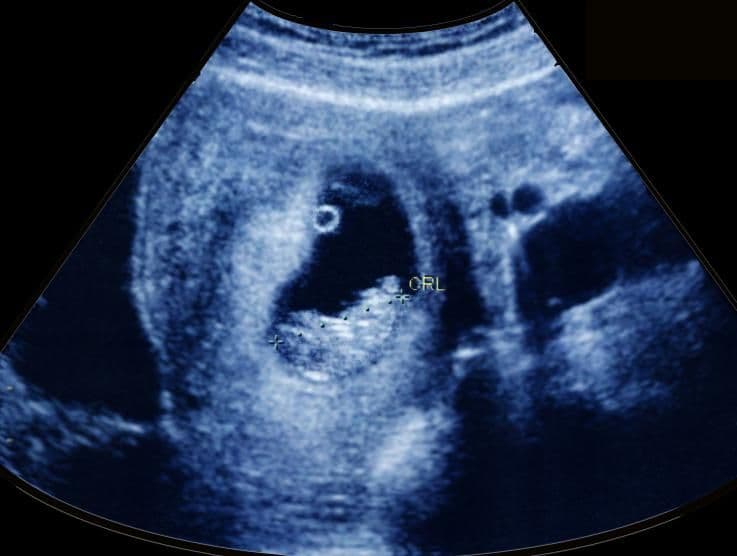 11 weeks and 2 days pregnant