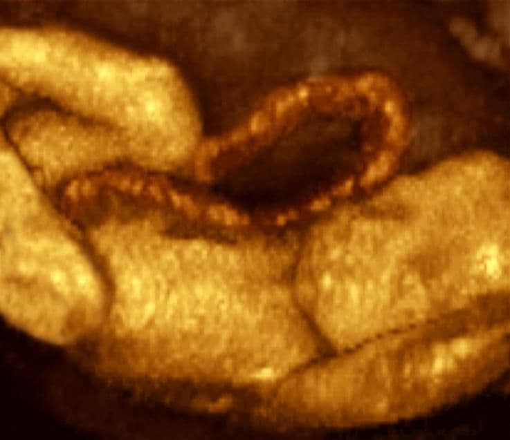 Ultrasound image at pregnancy week 26