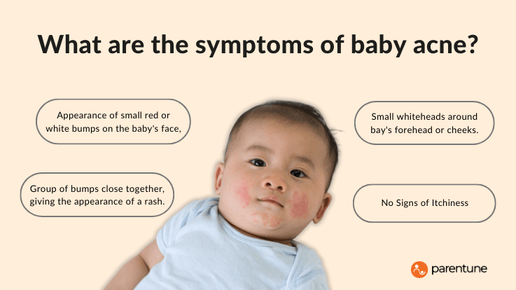 What are the symptoms of baby acne?