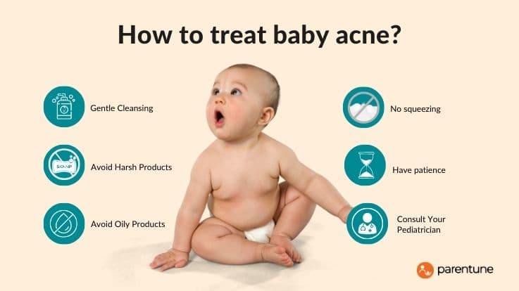 How to treat baby acne?